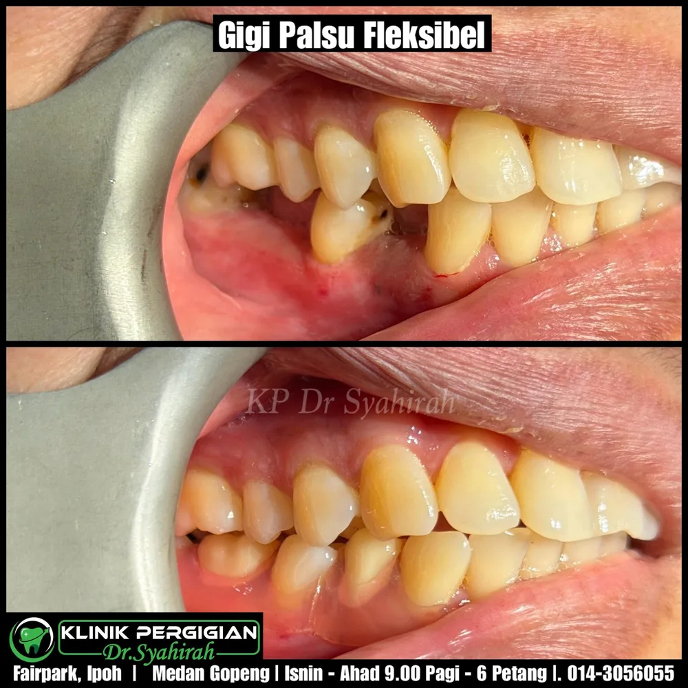 Gigi palsu fleksibel