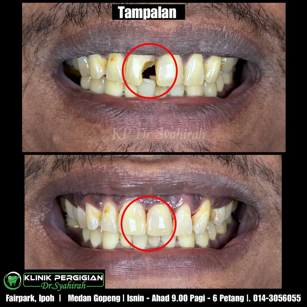 Tampal dan cabut gigi