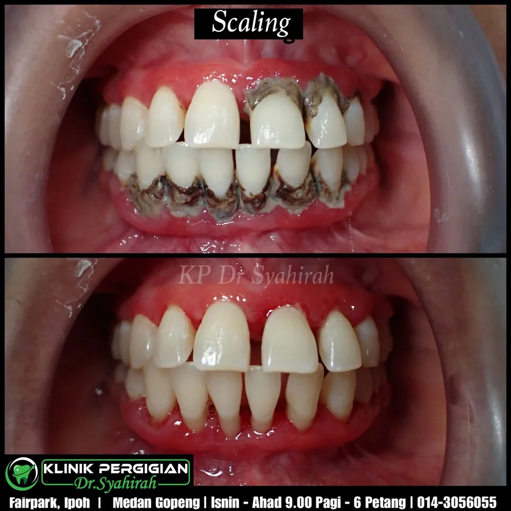 Scaling / cuci gigi